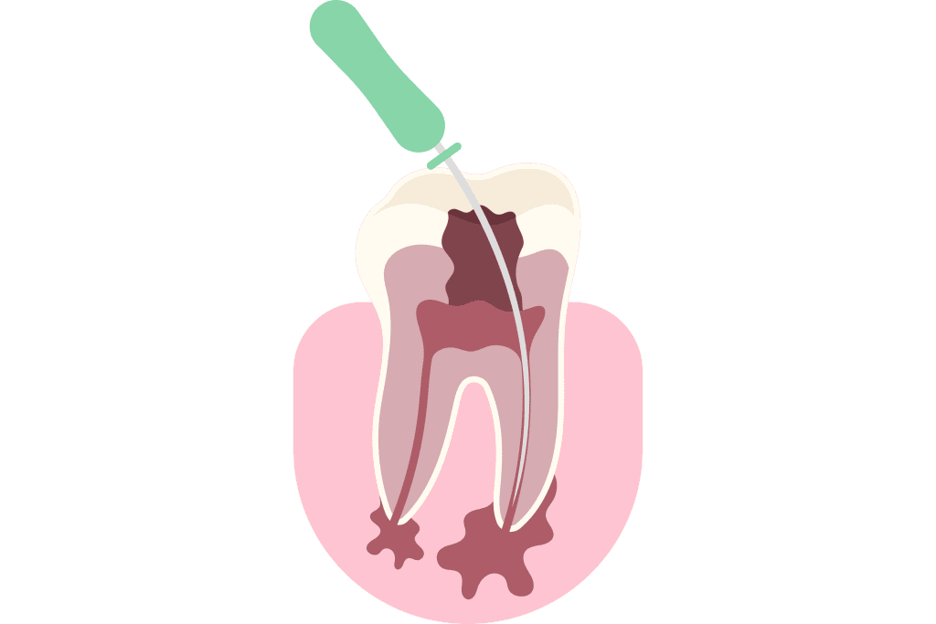 علاج جذور الاسنان