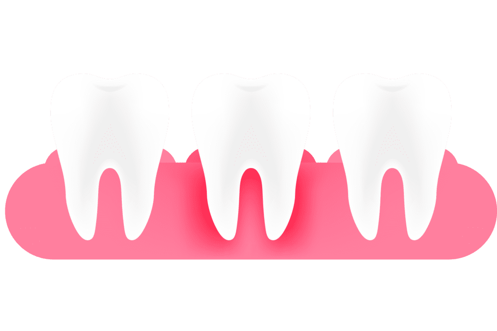 التهاب اللثه