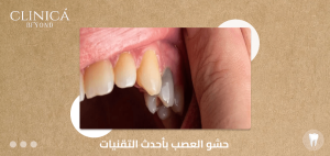 حشو العصب بأحدث التقنيات