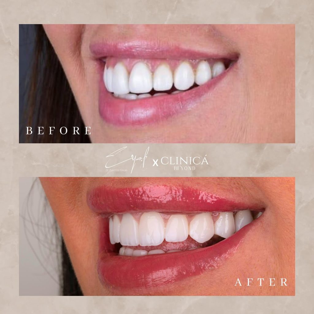 فينير-الاسنان-قبل-بعد