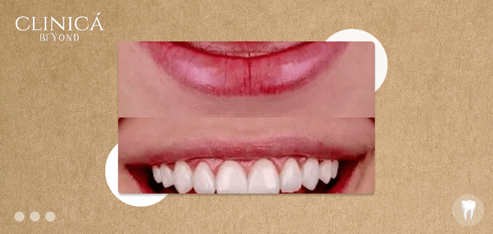 الابتسامة اللثوية