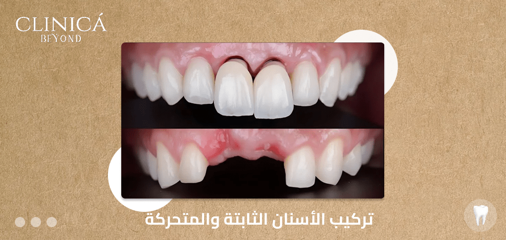 تركيب الأسنان الثابتة والمتحركة