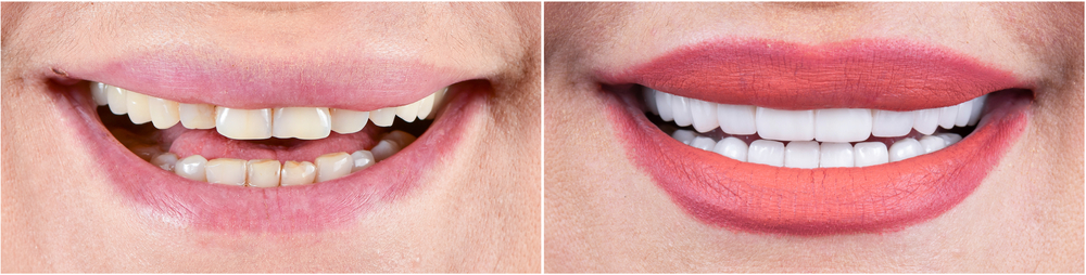 سعر-هوليود-سمايل