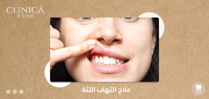 علاج التهاب اللثة