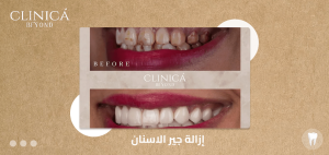 إزالة جير الاسنان