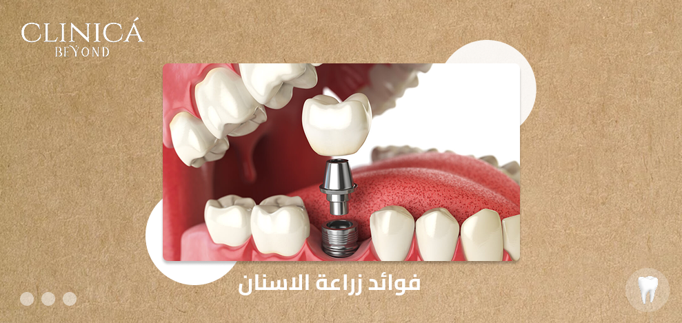 فوائد زراعة الاسنان