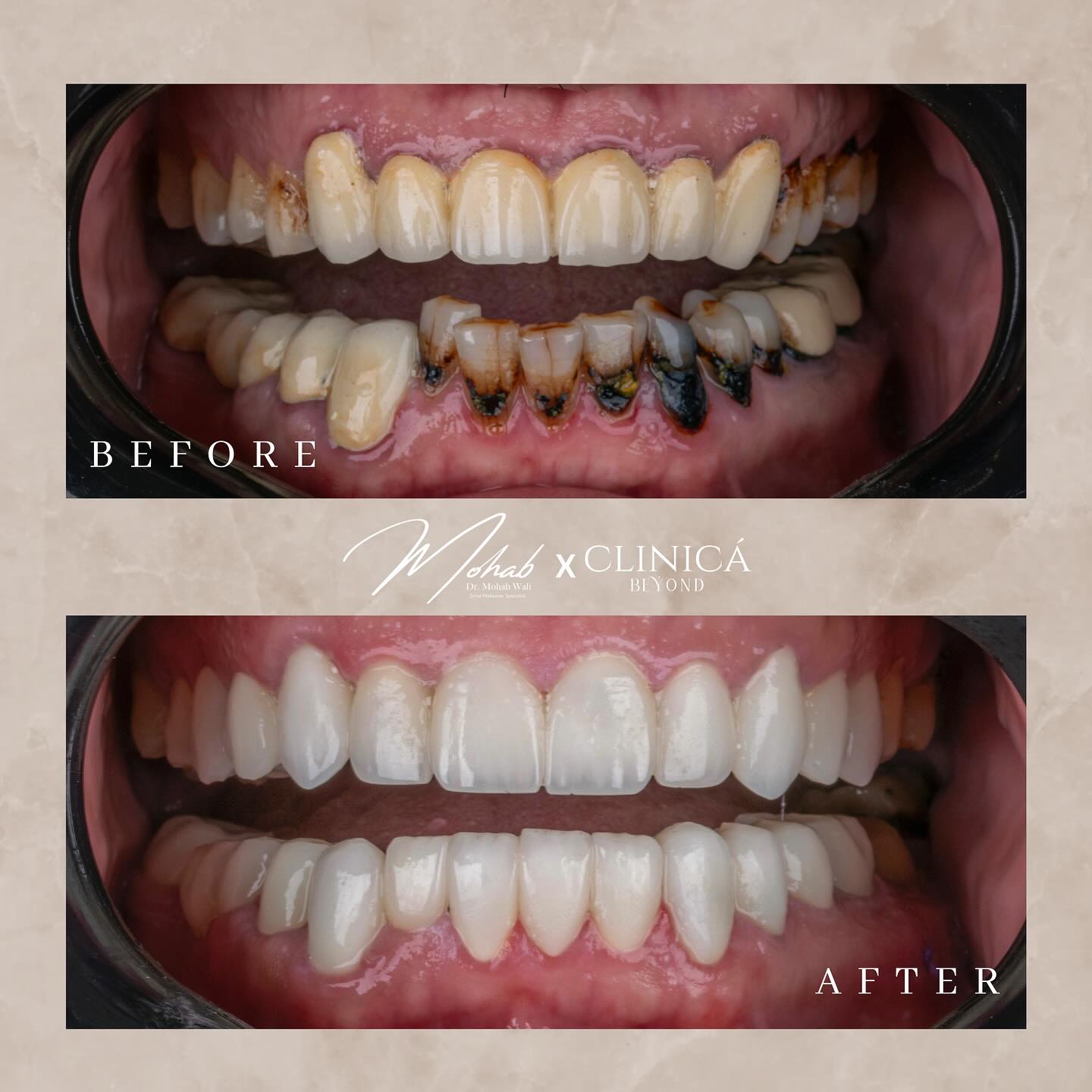 حشو-تنظيف-الاسنان