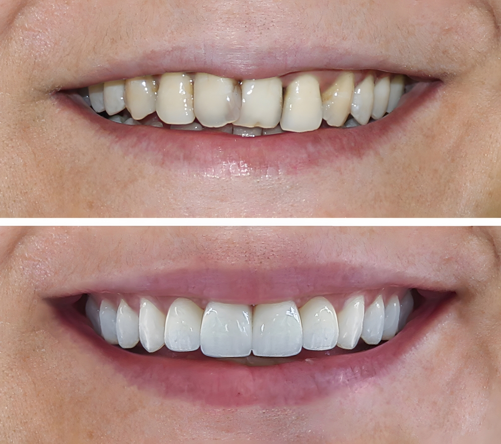 سعر-الكومبوزيت-فينير