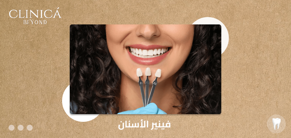 فينير الأسنان