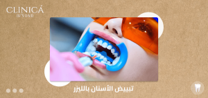 تبييض الأسنان بالليزر