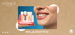 زراعة الاسنان فى مصر