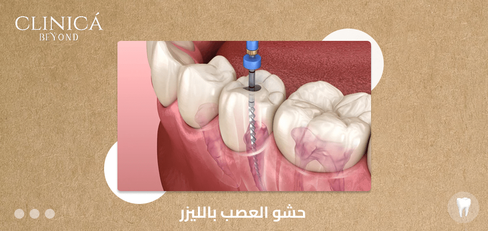 حشو العصب بالليزر