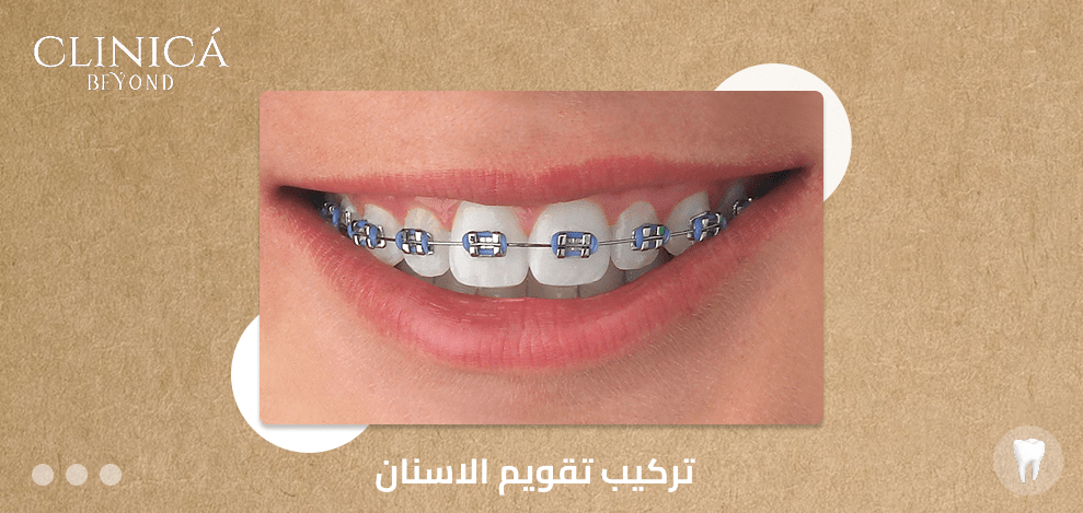 تركيب تقويم الاسنان
