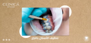 تنظيف الأسنان بالليزر