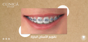 تقويم الأسنان البارزة