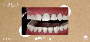 قص اللثة بالليزر