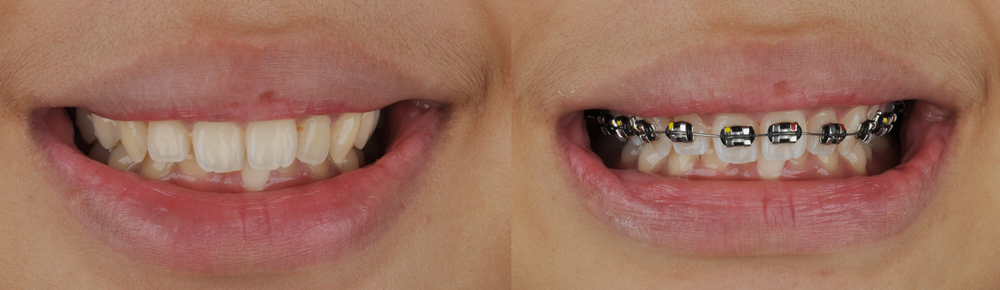 تقويم-الاسنان-لسن-واحد-قبل-بعد