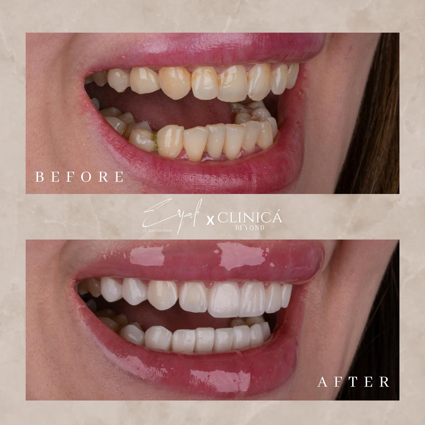 سعر-تقويم-الاسنان-البارزة