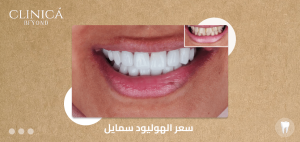 سعر الهوليود سمايل