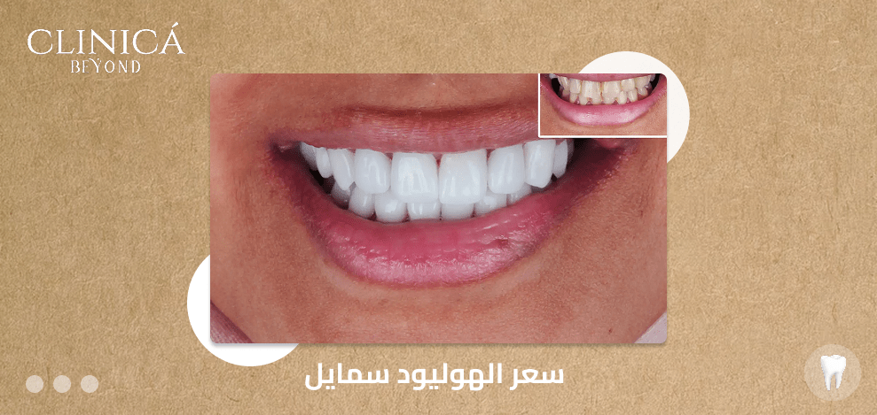 سعر الهوليود سمايل