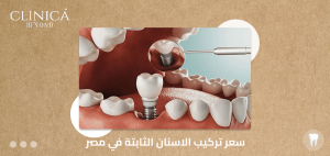 سعر تركيب الاسنان الثابتة في مصر