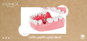 اسعار تركيب الضرس الثابت