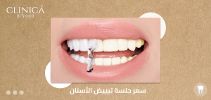 سعر جلسة تبييض الأسنان