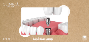 تركيب سنة ثابتة