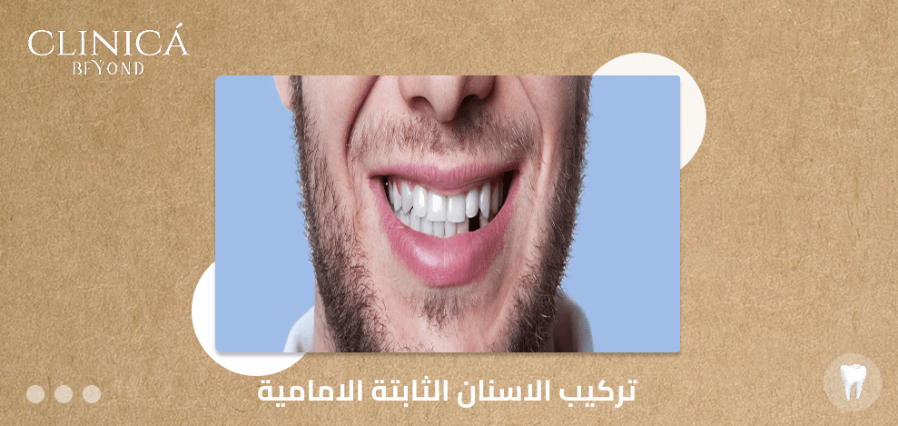 تركيب الاسنان الثابتة الامامية