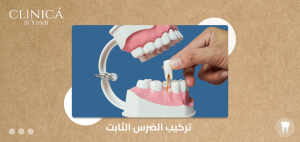 تركيب الضرس الثابت