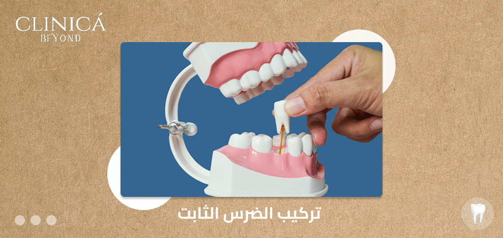 تركيب الضرس الثابت