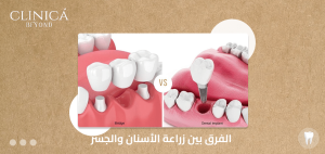 زراعة الاسنان والجسر