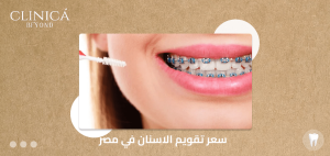 سعر تقويم الاسنان في مصر