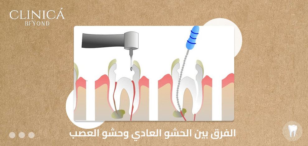 الفرق بين الحشو العادي وحشو العصب