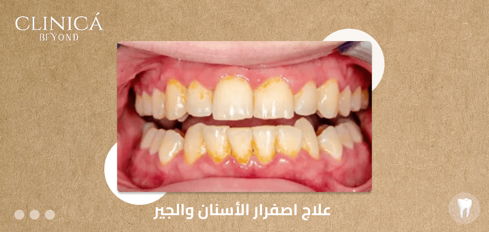 علاج اصفرار الأسنان والجير