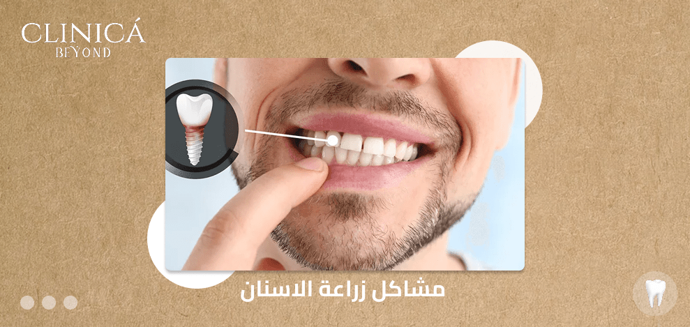 مشاكل زراعة الاسنان
