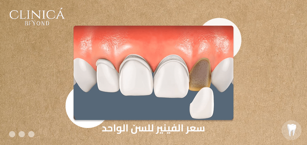 سعر الفينير للسن الواحد