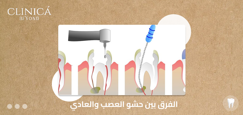 الفرق بين حشو العصب والعادي