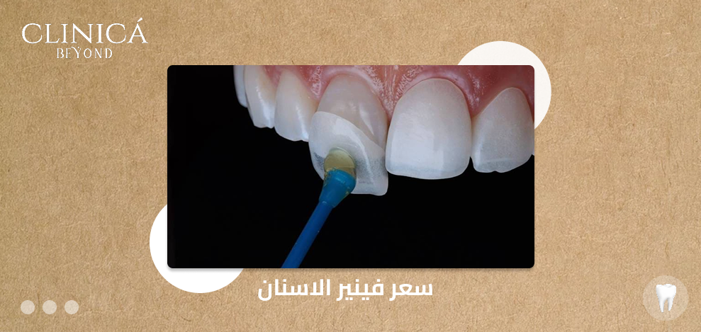 سعر فينير الاسنان