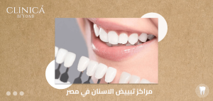 مراكز تبييض الاسنان في مصر