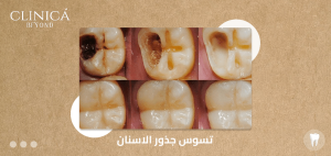 تسوس جذور الاسنان