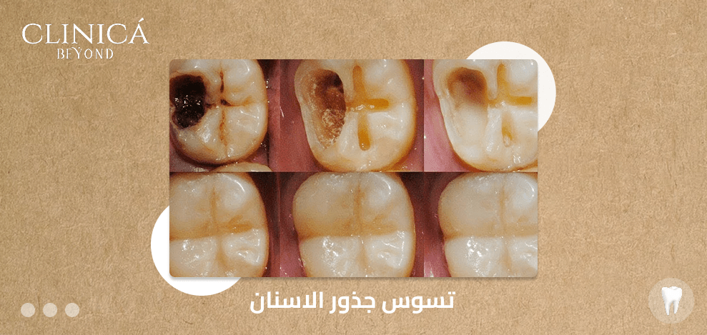 تسوس جذور الاسنان