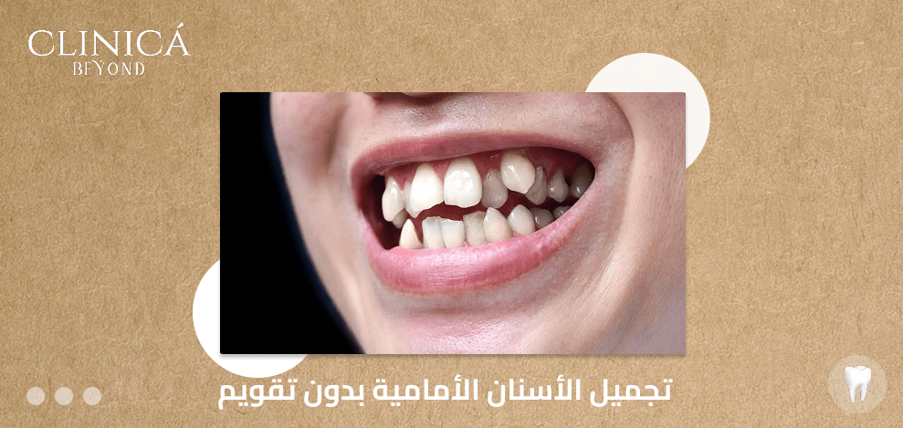 تجميل الأسنان الأمامية بدون تقويم