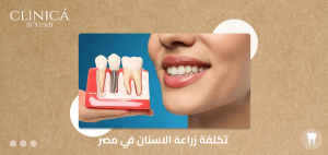 تكلفة زراعة الاسنان في مصر