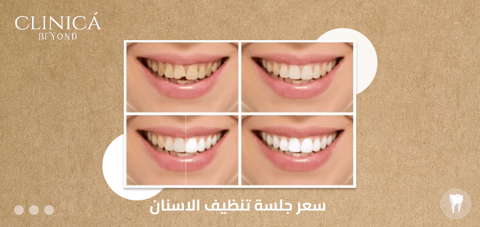 سعر جلسة تنظيف الاسنان