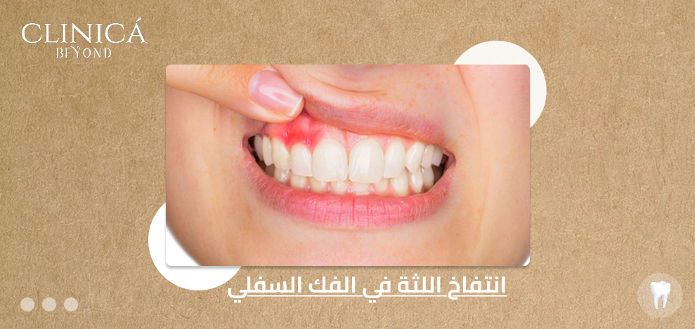 انتفاخ اللثة في الفك السفلي