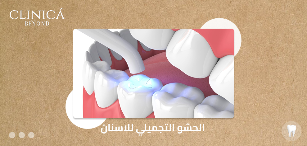 الحشو التجميلي للاسنان