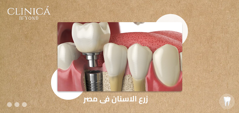 زرع الاسنان فى مصر