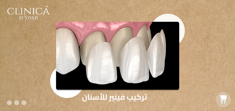 تركيب فينير للأسنان