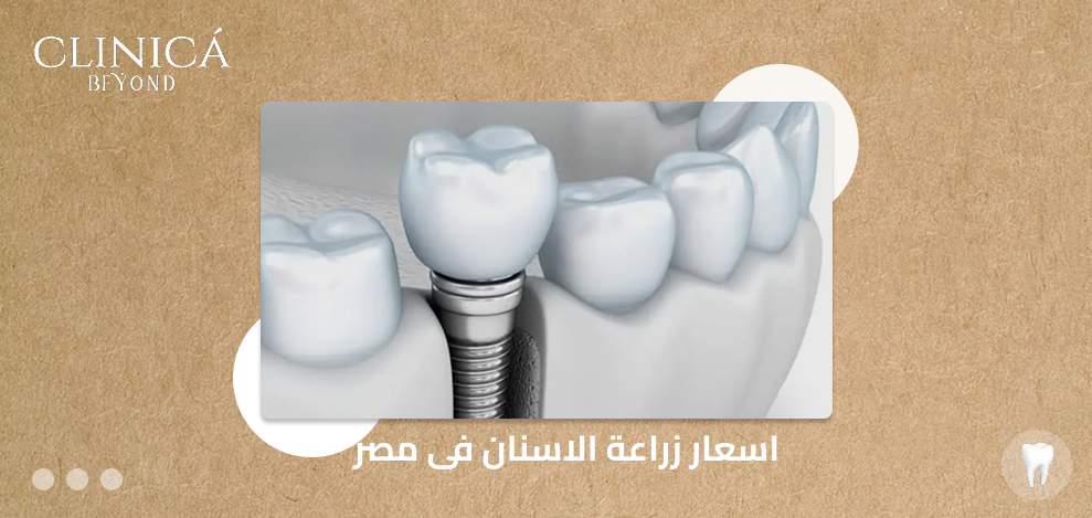 اسعار زراعة الاسنان فى مصر​